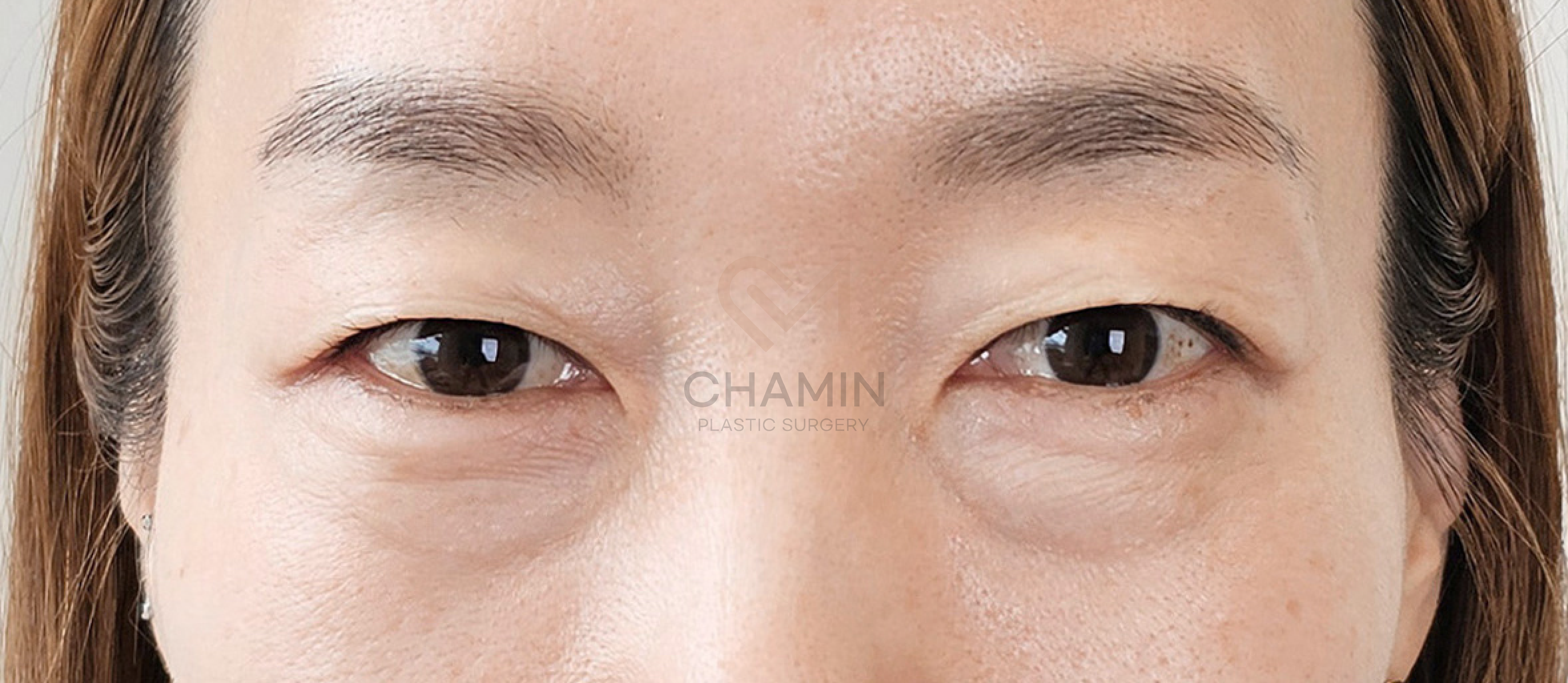 Functional Muscle Correction (Ptosis) - Before