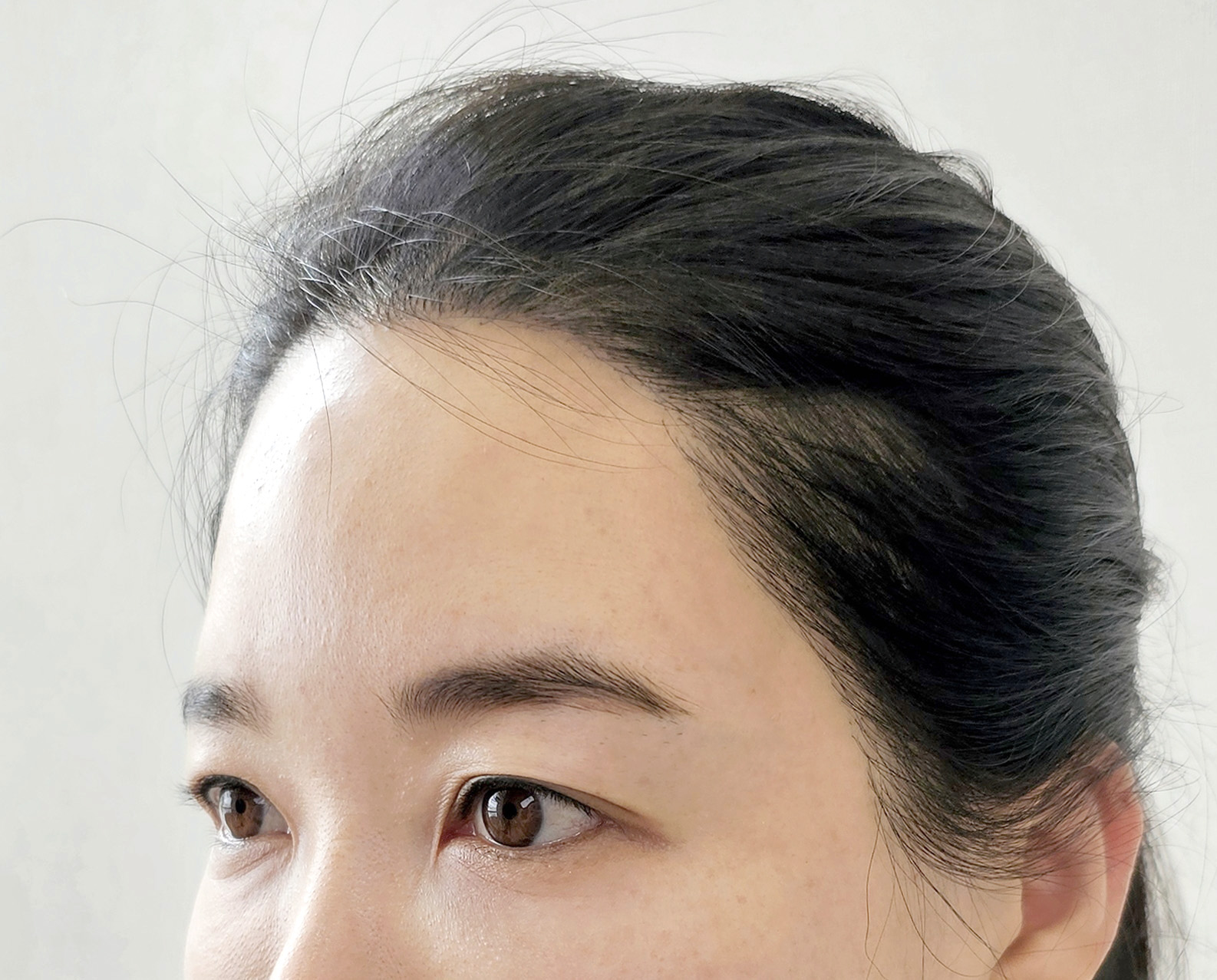 Forehead & Brow Rejuvenation - Before