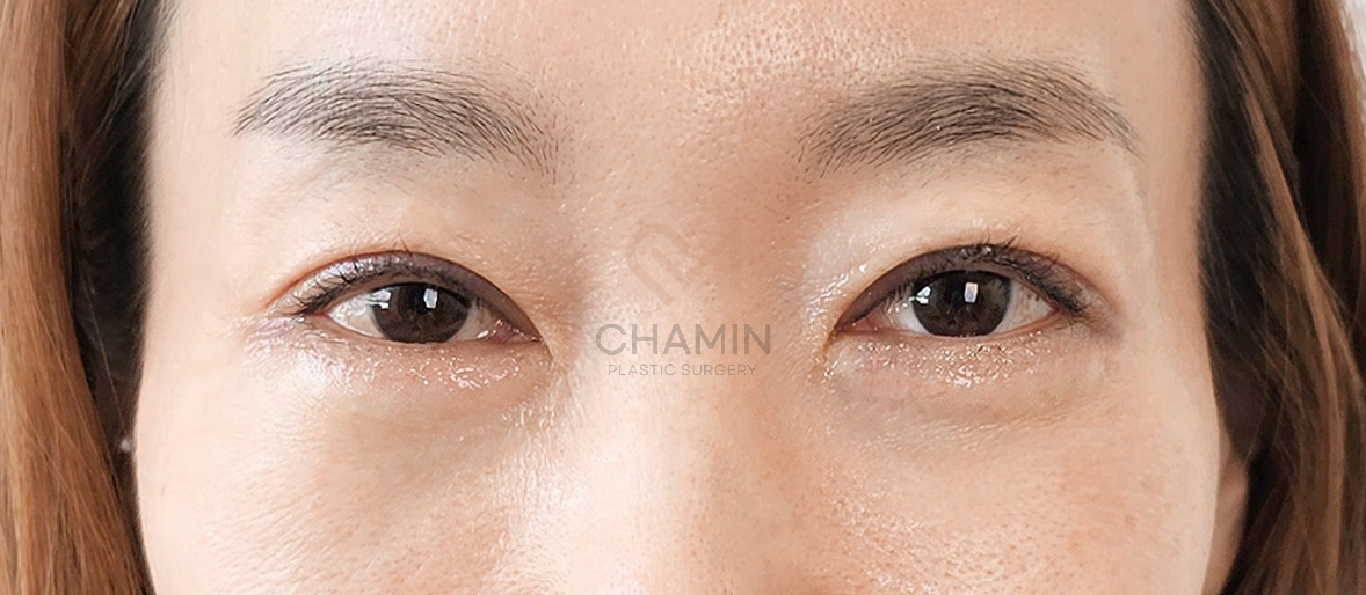 Functional Muscle Correction (Ptosis) - After