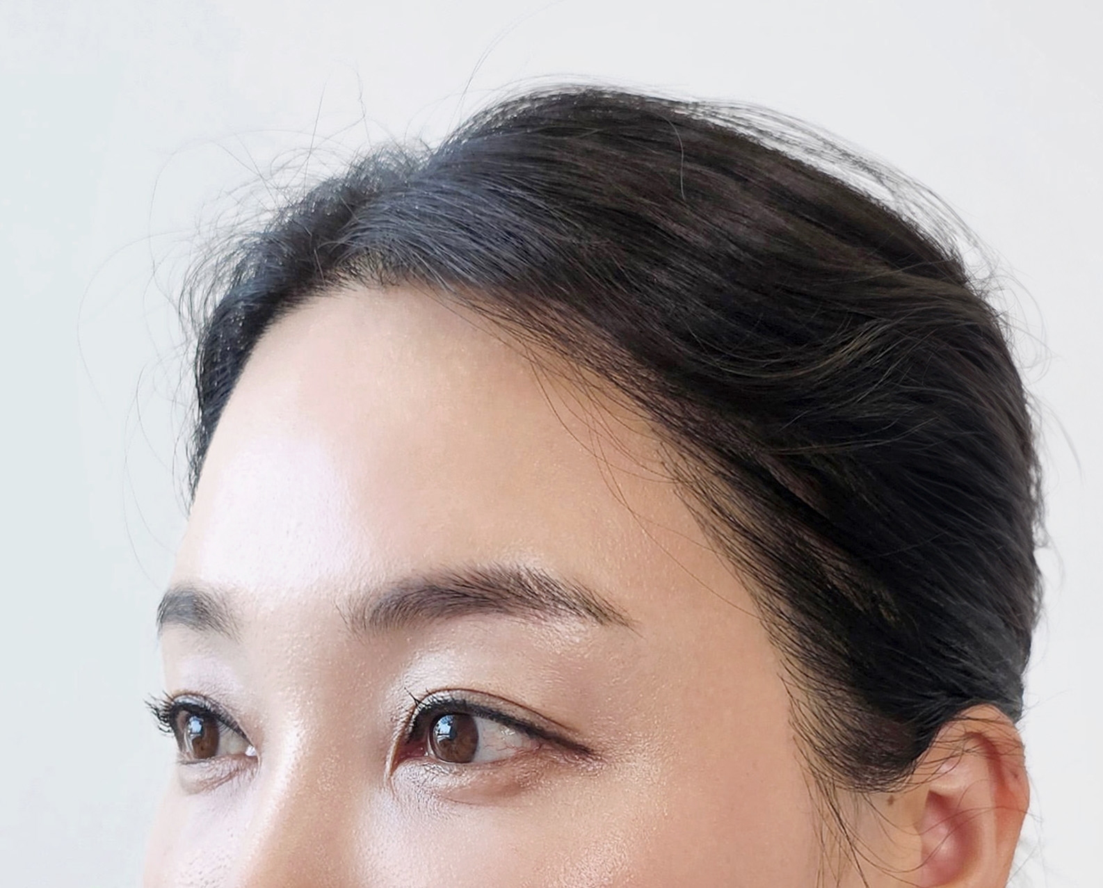 Forehead & Brow Rejuvenation - After