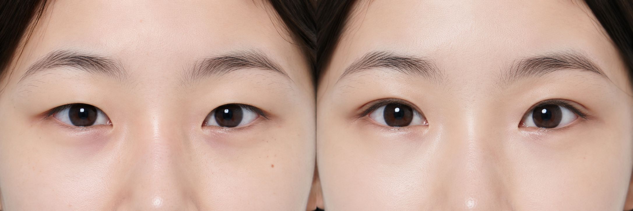 Eye Reshaping (Canthoplasty) - Before and After