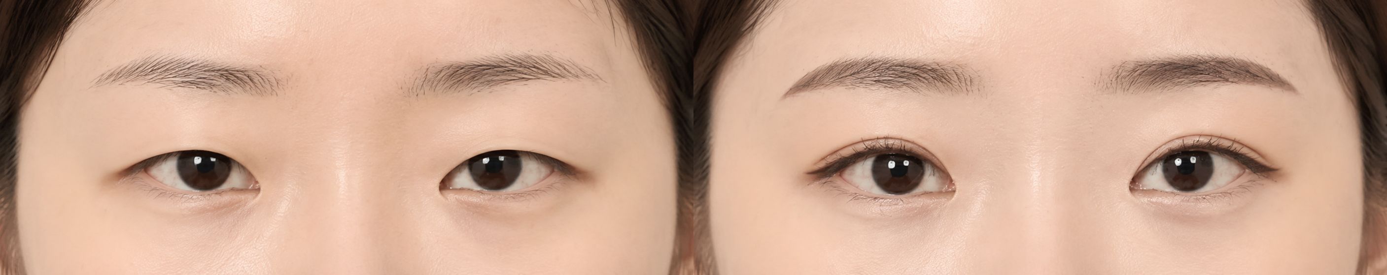 Double Eyelid Surgery (Blepharoplasty) - Before and After