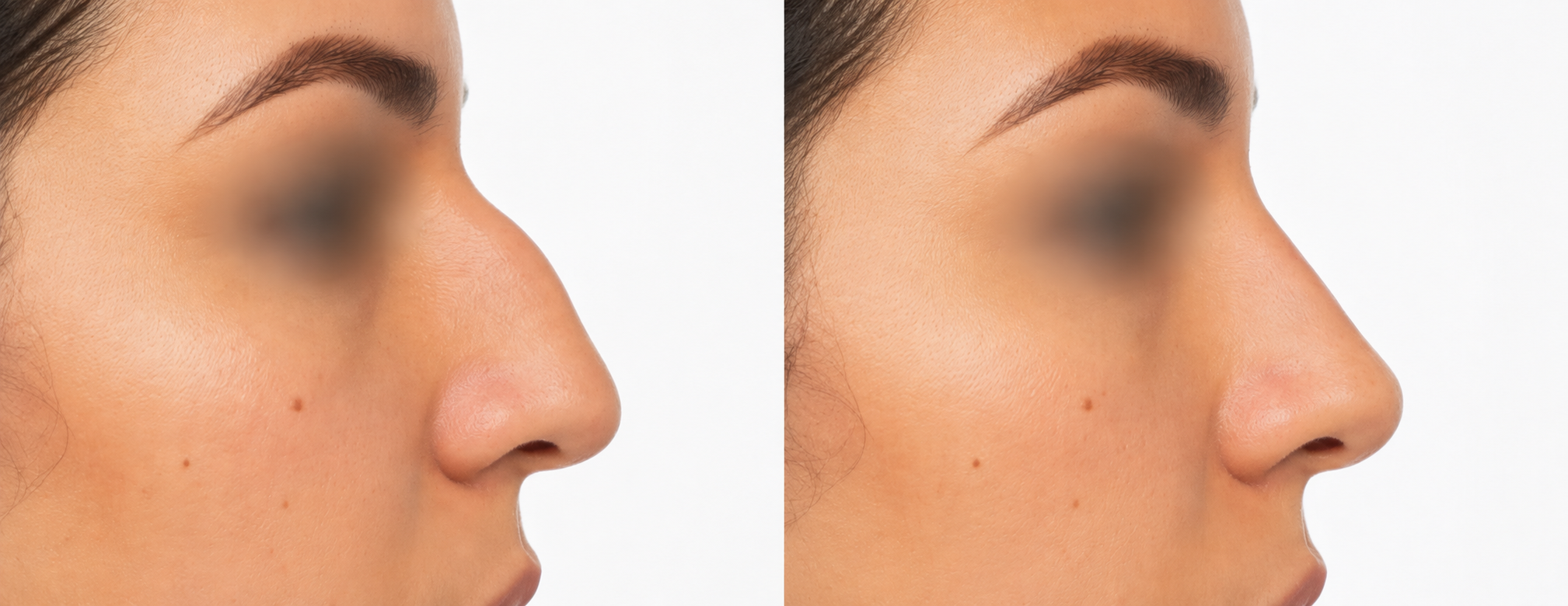 Hump Reduction - Before and After