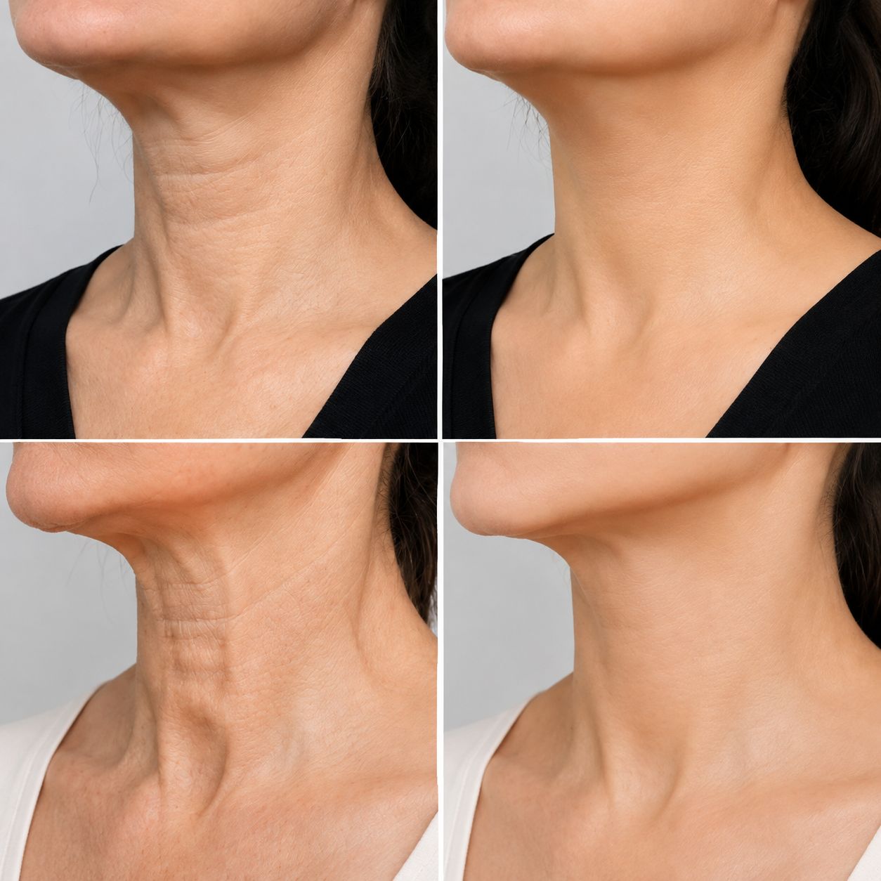 Neck Wrinkle Correction - Before and After