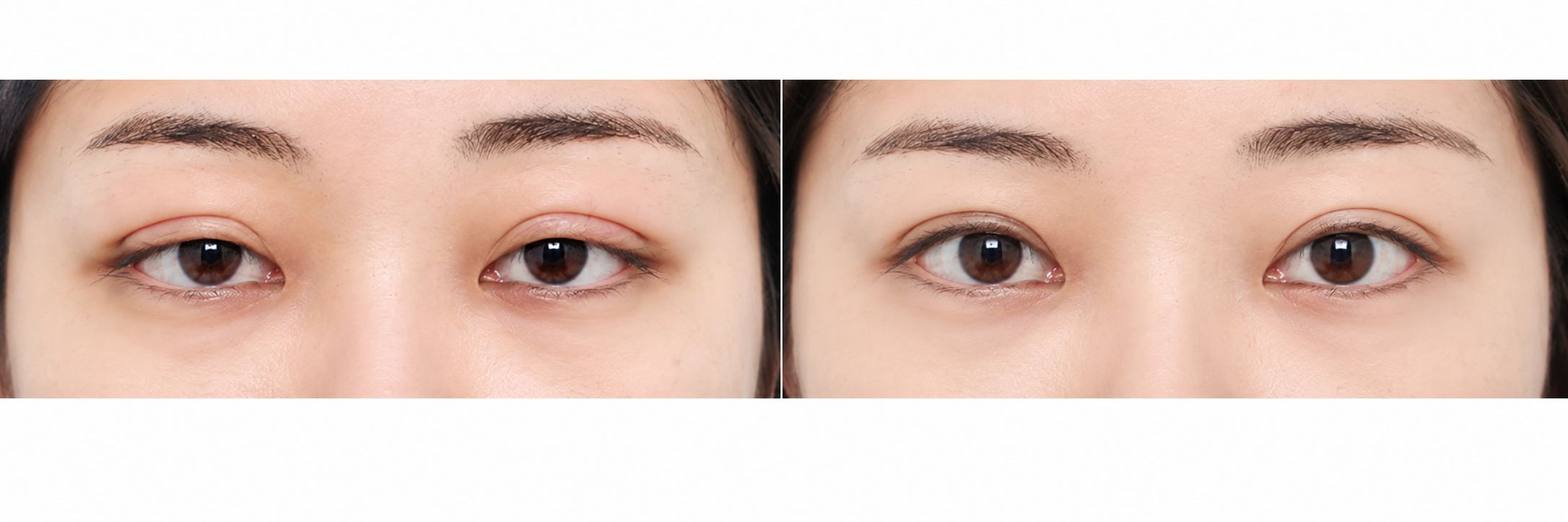 Revision Eye Surgery - Before and After